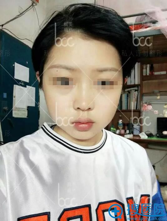 深圳科美整形医院假体隆下巴真实案例 回校惊艳所有人