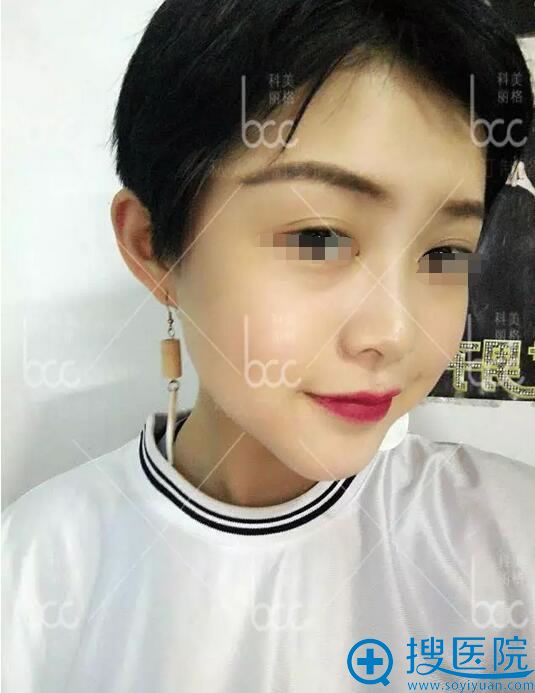 隆下巴术后22天,下巴线条自然流畅 隆下巴术后22天,下巴线条自然流畅