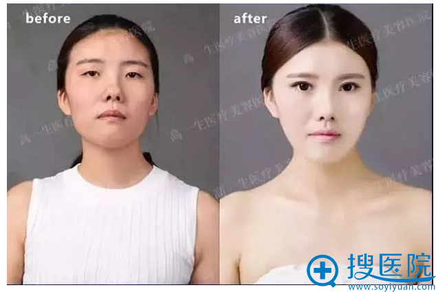 西安高一生双眼皮案例 西安高一生双眼皮案例
