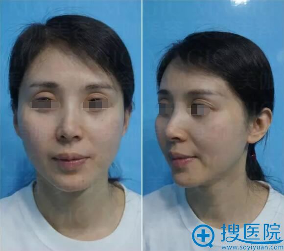 重庆美伽医院面部脂肪填充恢复视频 黄脸婆轻松变身时尚轻熟女