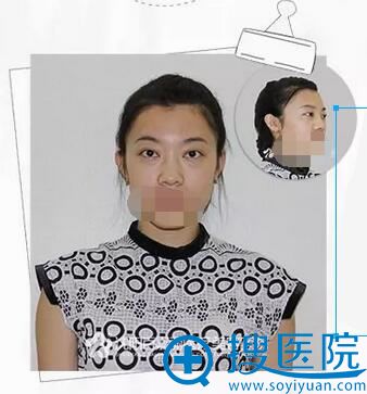 假体隆鼻术前照片 假体隆鼻术前照片