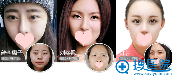 上海美莱张怀军双眼皮案例 上海美莱张怀军双眼皮案例