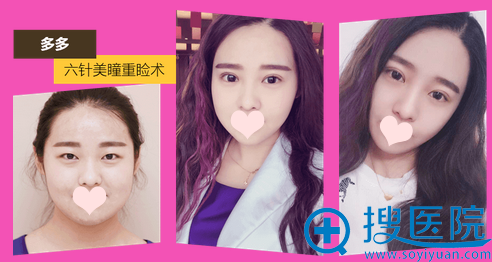 河南整形美容医院双眼皮案例 河南整形美容医院双眼皮案例