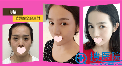 河南整形美容医院玻尿酸注射全脸案例 河南整形美容医院玻尿酸注射全脸案例