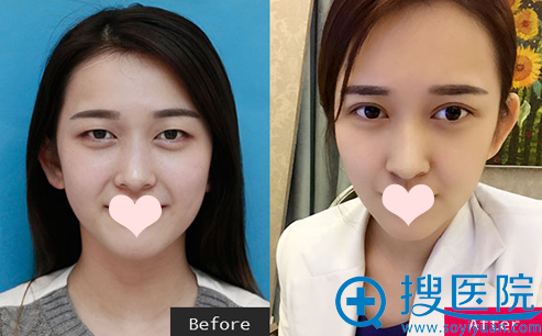 河南整形美容医院聂丽丽双眼皮案例 河南整形美容医院聂丽丽双眼皮案例