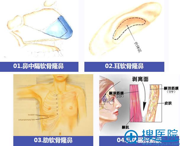 自体软骨隆鼻材料有哪些 自体软骨隆鼻材料有哪些