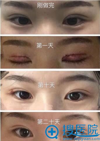 <!--<i data=20240710 data-id=1959></i>-->龙剑虹双眼皮术后恢复图 <!--<i data=20240710 data-id=1959></i>-->龙剑虹双眼皮术后恢复图