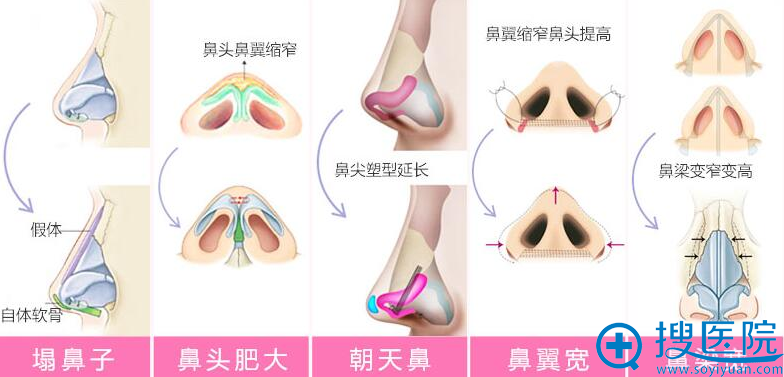 杭州时光鼻综合整形怎么样 鼻综合价钱贵吗?