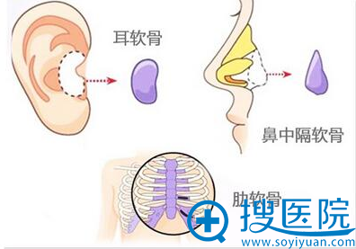 软骨隆鼻 软骨隆鼻