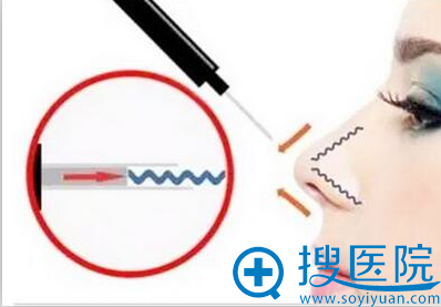 时光五维度综合隆鼻 时光五维度综合隆鼻