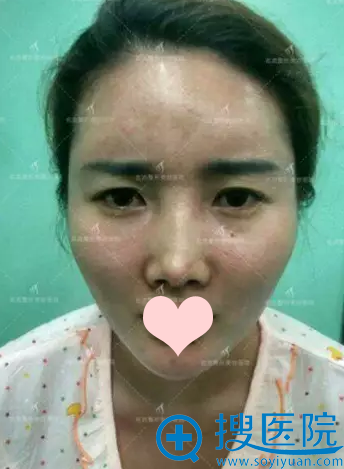 打工妹攒钱去沈阳名流整形医院做了鼻综合隆鼻和双眼皮
