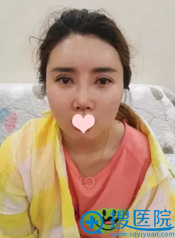 双眼皮+隆鼻第4天了 双眼皮+隆鼻第4天了