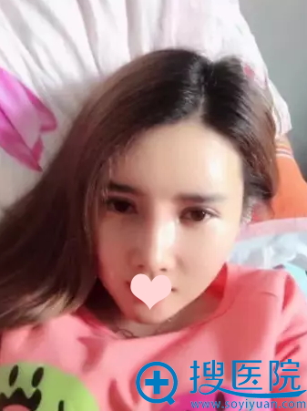 术后20天生活照 术后20天生活照
