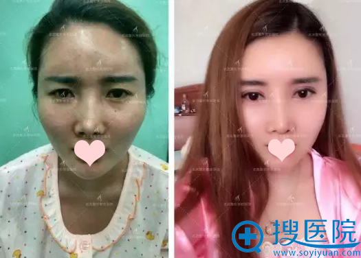 双眼皮+隆鼻前后对比照 双眼皮+隆鼻前后对比照