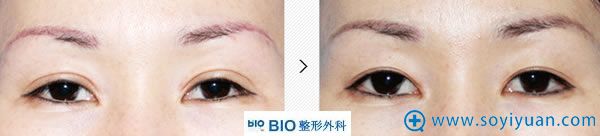 韩国BIO的双眼皮修复案例 韩国BIO的双眼皮修复案例