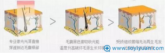 冰点无痛脱毛原理 冰点无痛脱毛原理