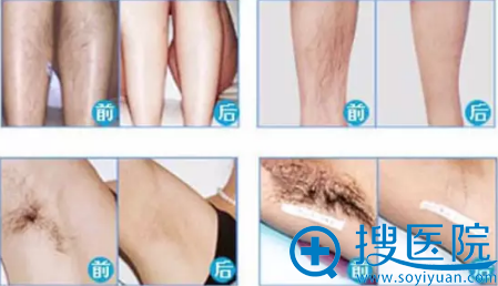 深圳仁安雅冰点脱毛术后对比效果 深圳仁安雅冰点脱毛术后对比效果
