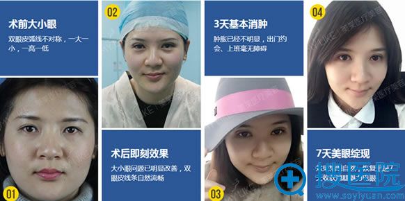 广州美莱双眼皮7天恢复效果 广州美莱双眼皮7天恢复效果