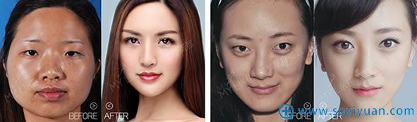 广州美莱整形双眼皮真实案例 广州美莱整形双眼皮真实案例