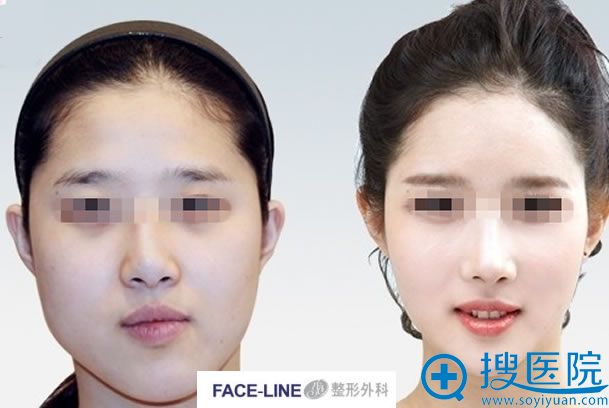 韩国FACELINE双鄂手术案例 韩国FACELINE双鄂手术案例