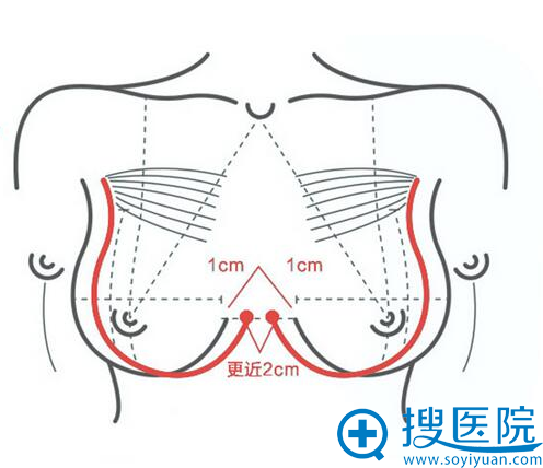 扬州施尔美深V动感丰胸怎么样 施尔美整形价目表!