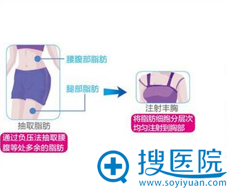 自体脂肪丰胸 自体脂肪丰胸