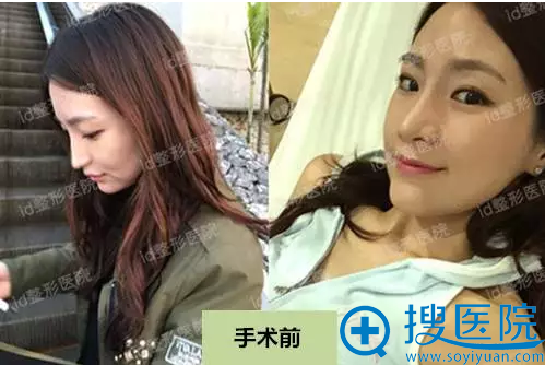 韩国id整容医院隆鼻失败修复案例 30岁上班族的鼻整形真实后记