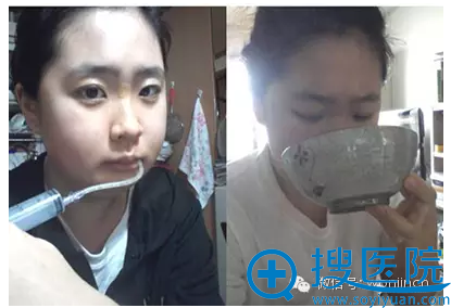 双颚整形术后第7天效果 双颚整形术后第7天效果