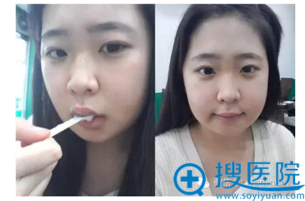 双颚整形术后第20天的样子 双颚整形术后第20天的样子