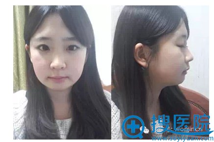 双颚整形术后2个月的我 双颚整形术后2个月的我