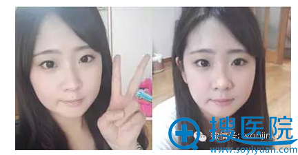 双颚整形术后3个月的样子 双颚整形术后3个月的样子