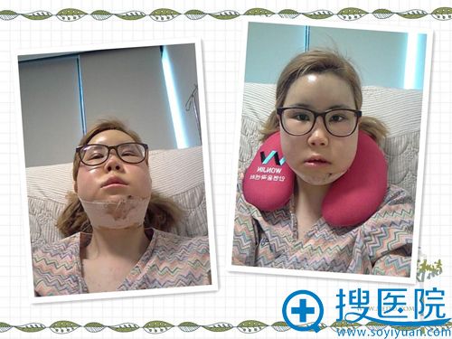 在原辰做面部轮廓手术第三天照片 在原辰做面部轮廓手术第三天照片