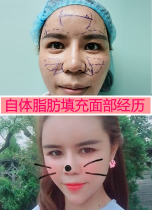 北京俯大医疗美容王家贵自体脂肪填充额头、苹果肌、法令纹案例