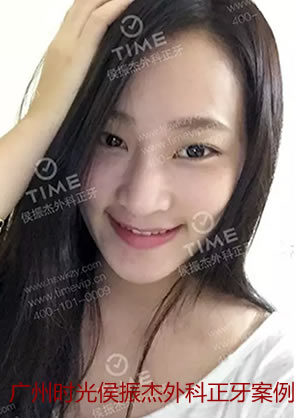 广州时光侯振杰外科正牙地包天牙齿矫正案例 术后美丽大变身