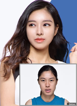 韩国Dream(德琳)面部整形案例 改头换面成就泰国女神