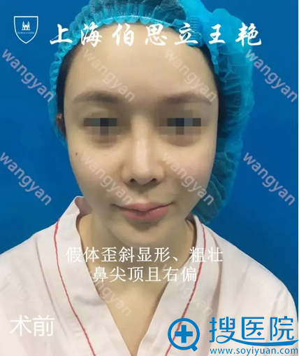 上海百达丽整形医院王艳隆鼻案例 自然挺翘就是这么简单