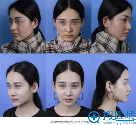 新疆女<!--<i data=20240710 data-id=1877></i>-->生祛斑整形前后 新疆女<!--<i data=20240710 data-id=1877></i>-->生祛斑整形前后
