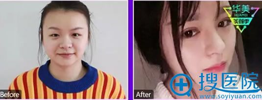 贵阳华美整形隆鼻前后对比照 贵阳华美整形隆鼻前后对比照