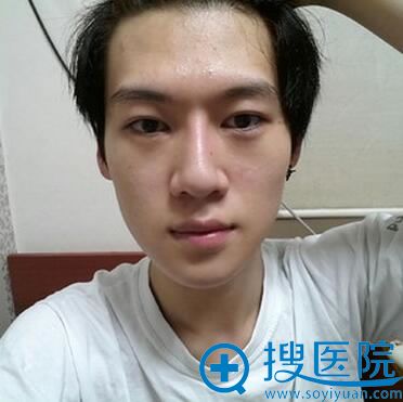 韩国丽珍整形医院吴铭埈失败修复手术:双鄂+V-line