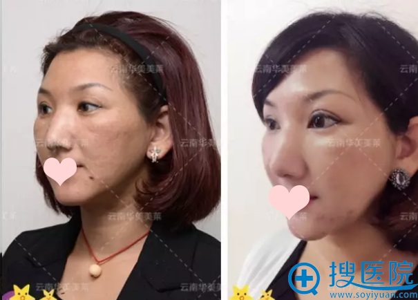 双眼皮修复前后对比图 双眼皮修复前后对比图