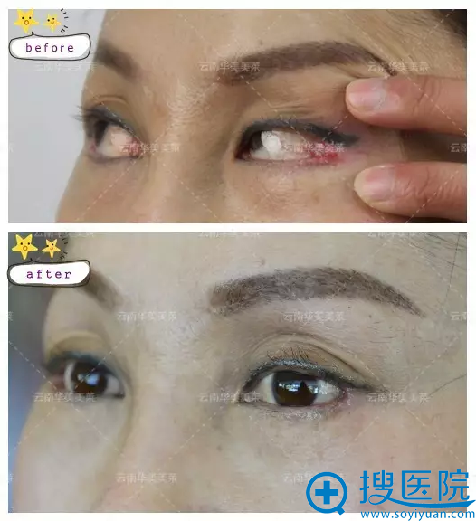 刘辅蓉双眼皮失败修复前后对比图 刘辅蓉双眼皮失败修复前后对比图