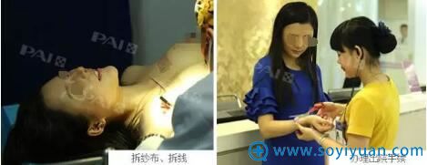 术后第四天拆线 术后第四天拆线