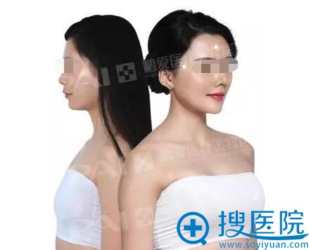 李罡假体丰胸+综合隆鼻手术前后对比 李罡假体丰胸+综合隆鼻手术前后对比