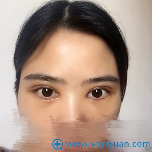 双眼皮第七天刚拆完线 双眼皮第七天刚拆完线