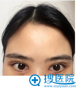 双眼皮手术第八天的样子 双眼皮手术第八天的样子