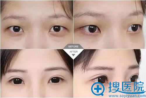 桂林时光美莱韩式双眼皮案例对比 桂林时光美莱韩式双眼皮案例对比