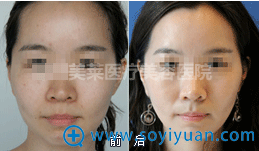 桂林时光美莱术后效果 桂林时光美莱术后效果