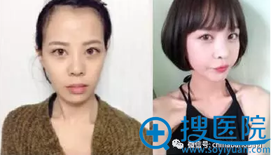 韩国巴诺巴奇整形外科Vline双颚隆鼻案例 从长脸到小V脸的转变
