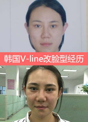 韩国妩丽林平珍院长v-line瓜子脸手术:下颌角+下巴改脸型