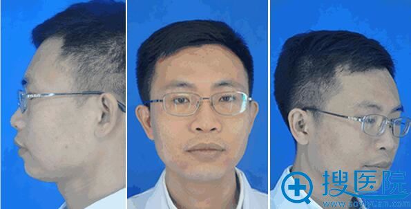 深圳富华注射医生李秀林亲身体验铂金瑞蓝玻尿酸丰下巴附对比照